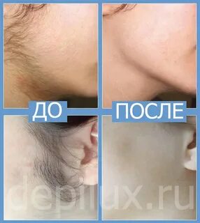 Что делать если на лице растут волосы