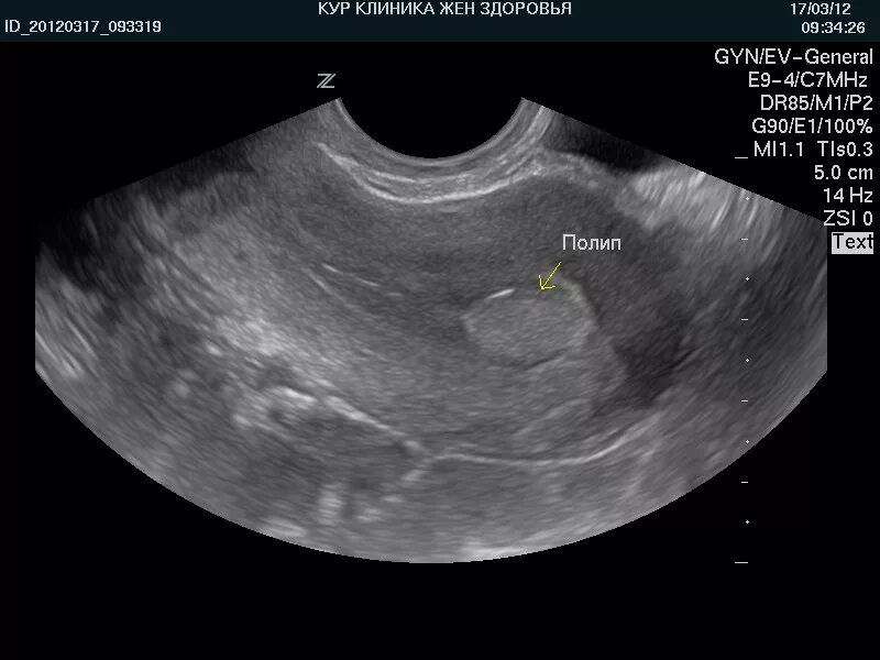 Эхограммы полип эндометрия. Плацентарный полип на УЗИ. На узи видно рак шейки