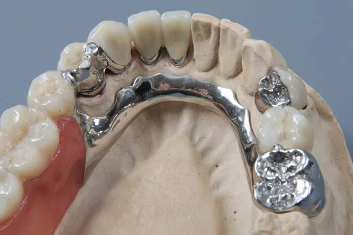 Несъемные мостовидные протезы. Коронка цельнолитая кхс. Цельнолитые несъемные протезы. Коронка металлокерамическая кхс что это. Мостовидные протезы металл цельнолитые.