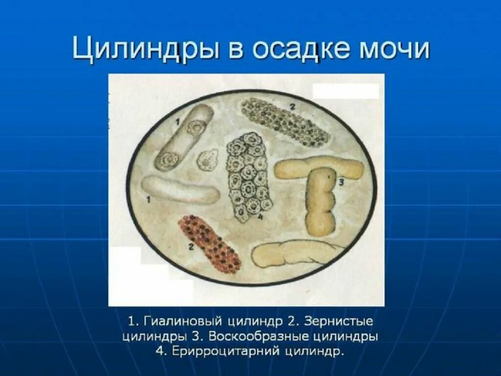 Моча цилиндры гиалиновые повышенные. Гиалиновые зернистые и восковидные цилиндры в моче. Цилиндрурия гиалиновые цилиндры. Гиалиновые цилиндры микроскопия. Гиалиновые цилиндры в моче.