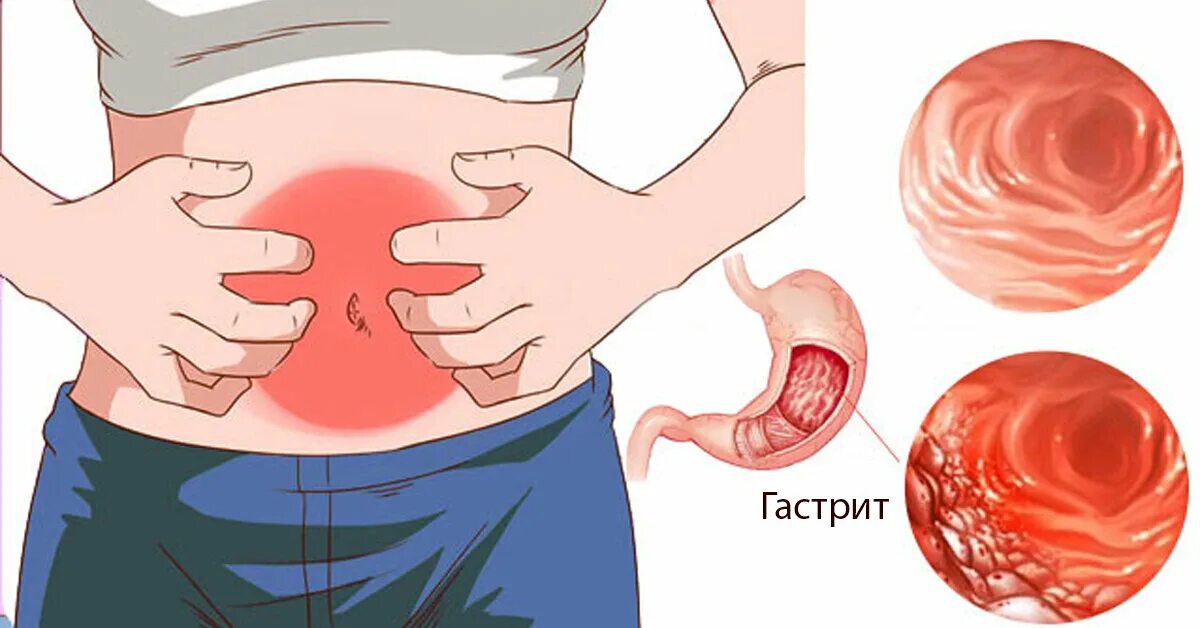 Боли в желудке после острого. Боли при гастрите.