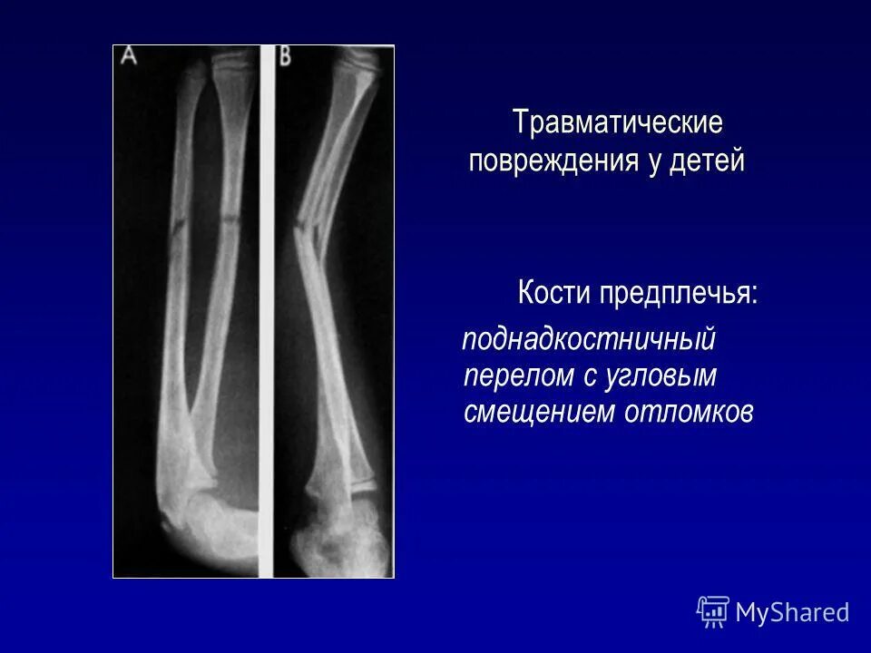 лучевая кость смещение допустимое. перелом диафиза лучевой кости гипс. перелом галеацци остеосинтез. гипоплазия лучевой кости. винтообразный перелом лучевой кости.