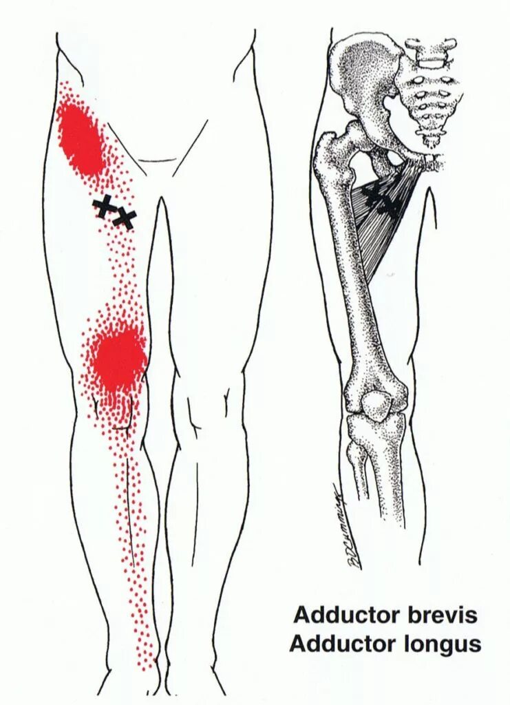 Почему тянет левую ногу. Триггерные точки четырехглавой мышцы бедра. Триггерные точки тазобедренного сустава и бедра. Триггерные точки квадрицепс. Триггерные точки мышц бедра.