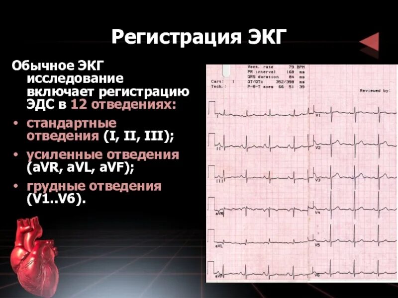 12 Отведений ЭКГ схема норма. 3 Стандартное отведение ЭКГ. Нормальное ЭКГ В 12 стандартных отведения. Нормальное ЭКГ В 3 отведении. Платные услуги экг