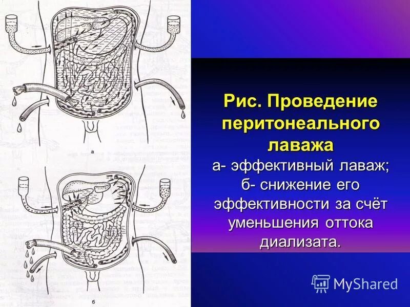 перитонеальный лаваж техника. перитонеальный лаваж и его бактериологическая оценка. перитонеальный лаваж. диагностический перитонеальный лаваж техника. перитониальный лаважа.