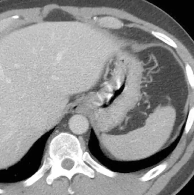 Гипоперфузия селезенки кт. Гемангиома селезенки кт. Кт селезенки с контрастированием. Распад селезенки