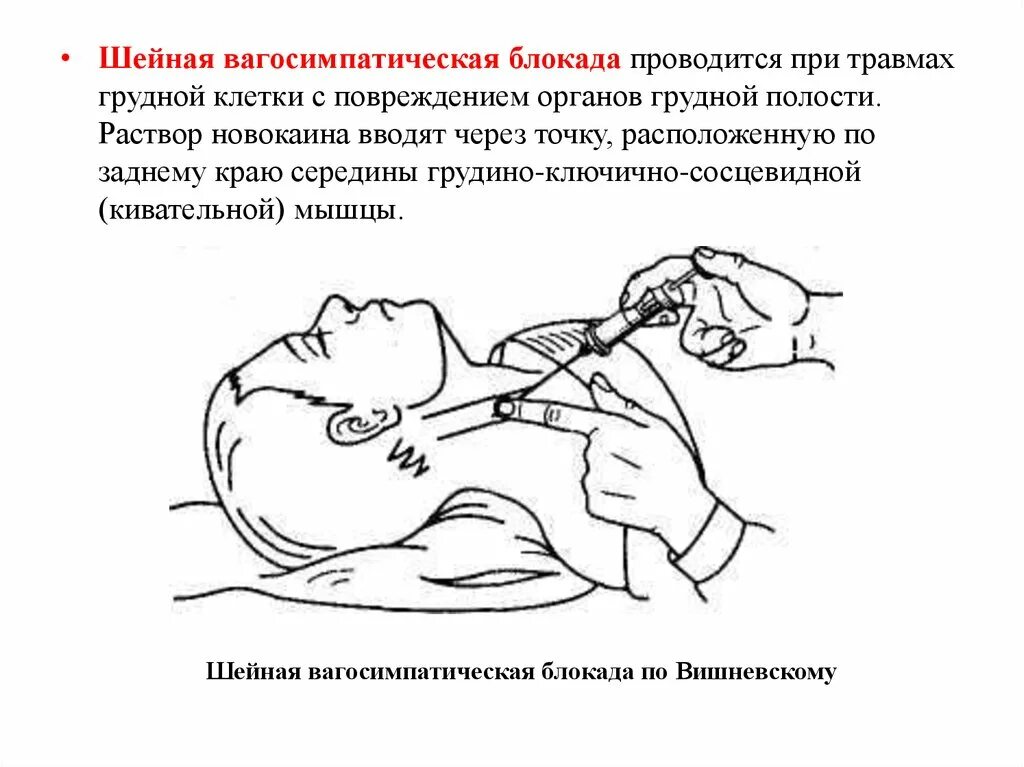 Блокада техника выполнения. Шейная вагосимпатическая блокада. Шейная вагосимпатическая новокаиновая блокада. Вагосимпатической блокады по а.в. Вишневскому. Вагосимпатическая блокада по Вишневскому.