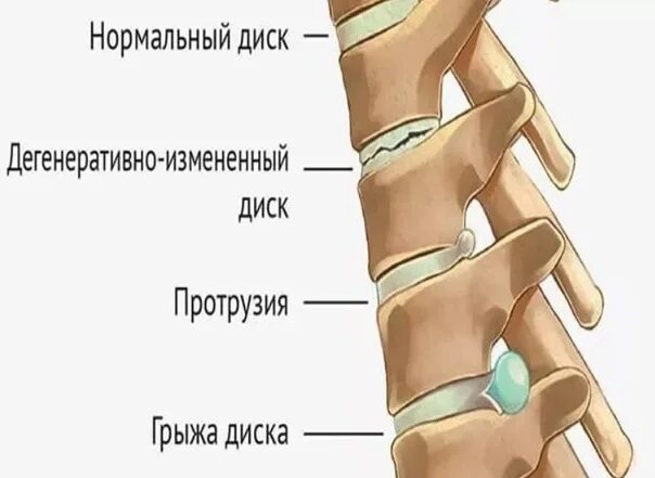 Позвоночный диск l5 s1 расположение фото Грыжа L5-S1 межпозвонкового диска поясничного отдела, лечение без операции в Мос