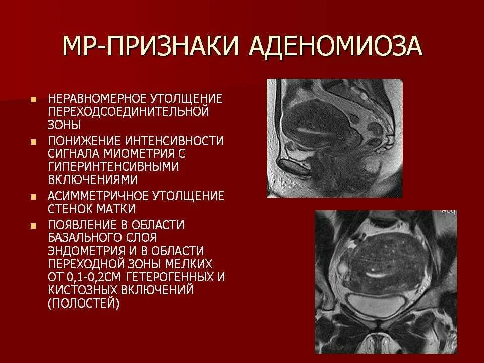 Степени диффузной формы аденомиоза. Диагностика аденомиоза.