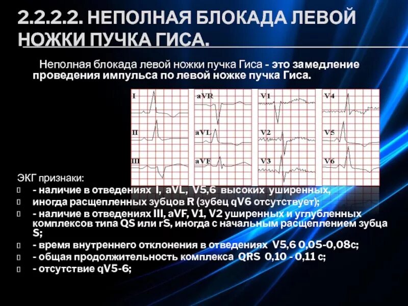 Признаки неполной блокады. Неполная блокада левой ножки пучка Гиса. Неполная блокада левой ножки пучка Гиса на ЭКГ. Неполная блокада левой ножки пучка на ЭКГ. Признаки неполной блокады левой ножки пучка Гиса.