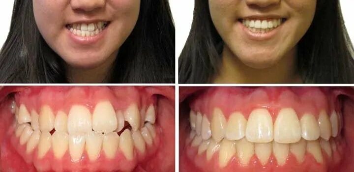 Элайнеры ортодонтия. Разобщением прикуса от 5 до 10 мм. Зубы идут вперед. Скученность зубов и перекрестный прикус. Мезиальный перекрестный прикус.