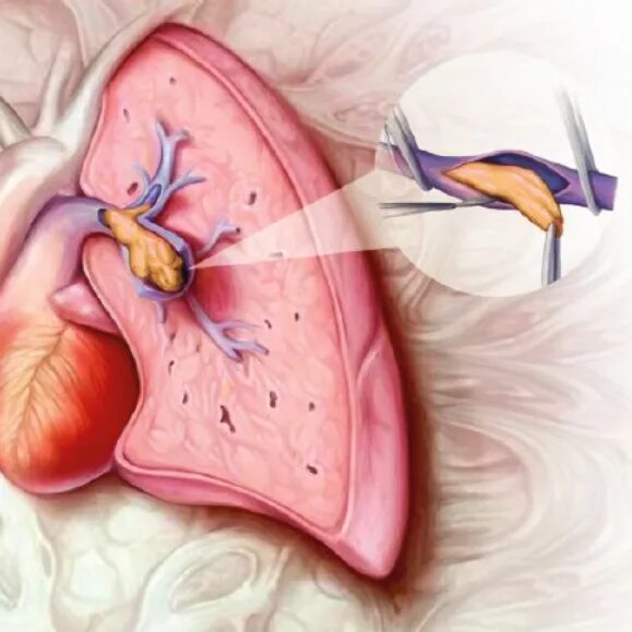 Тэла патологическая анатомия. Тромбоэмболия патанатомия. Тромбоэмболия легочной артерии патанатомия. Хроническая легочная тромбоэмболия. Оторвался тромб в легких