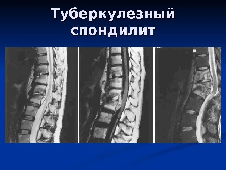 Асептический отек. Спондилит позвонков на кт. асептический спондилодисцит l5-s1. спондилит поясничного отдела кт. туберкулезный спондилит позвоночника на кт.