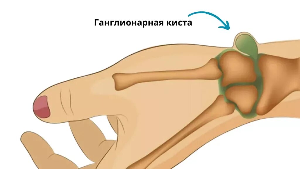 Гигрома лучезапястного сустава. Ганглий лучезапястного сустава. Гигрома лучезапястного сустава анатомия.