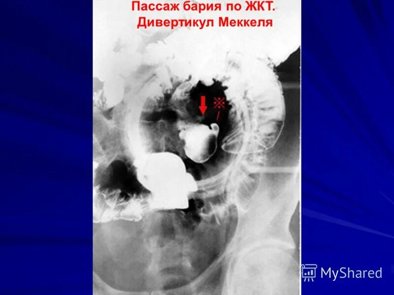 Пассаж бария по толстому кишечнику. Пассаж жкт. Толстокишечная непроходимость рентген пассаж бария. Рентген кишечника пассаж барием. Исследование пассажа бария по кишечнику.