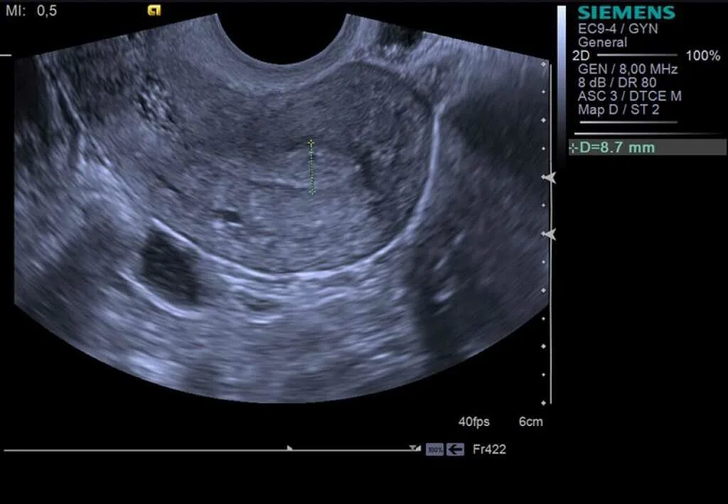 УЗИ матки измерения размеров. УЗИ малого таза яичники матка. Измерение шейки матки на УЗИ. Эндометриоз видно на узи