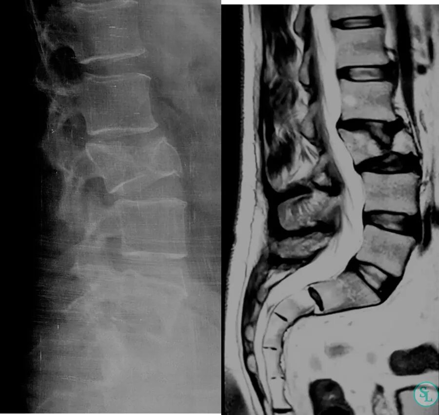 Компрессионный перелом l2 позвонка. Компрессионный перелом l1 позвонка. Компрессионный оскольчатый перелом позвоночника l1. Компрессионные переломы l2,l3,l4.
