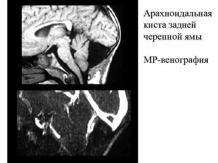 Арахноидальная киста задней черепной