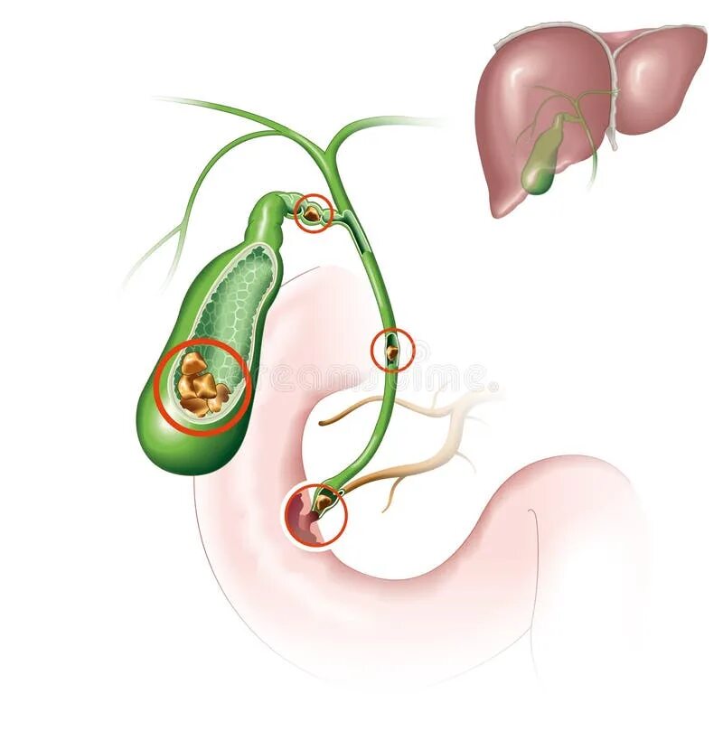Желчный пузырь рисунок. Камни в желчном пузыре иллюстрация. Берг желчный