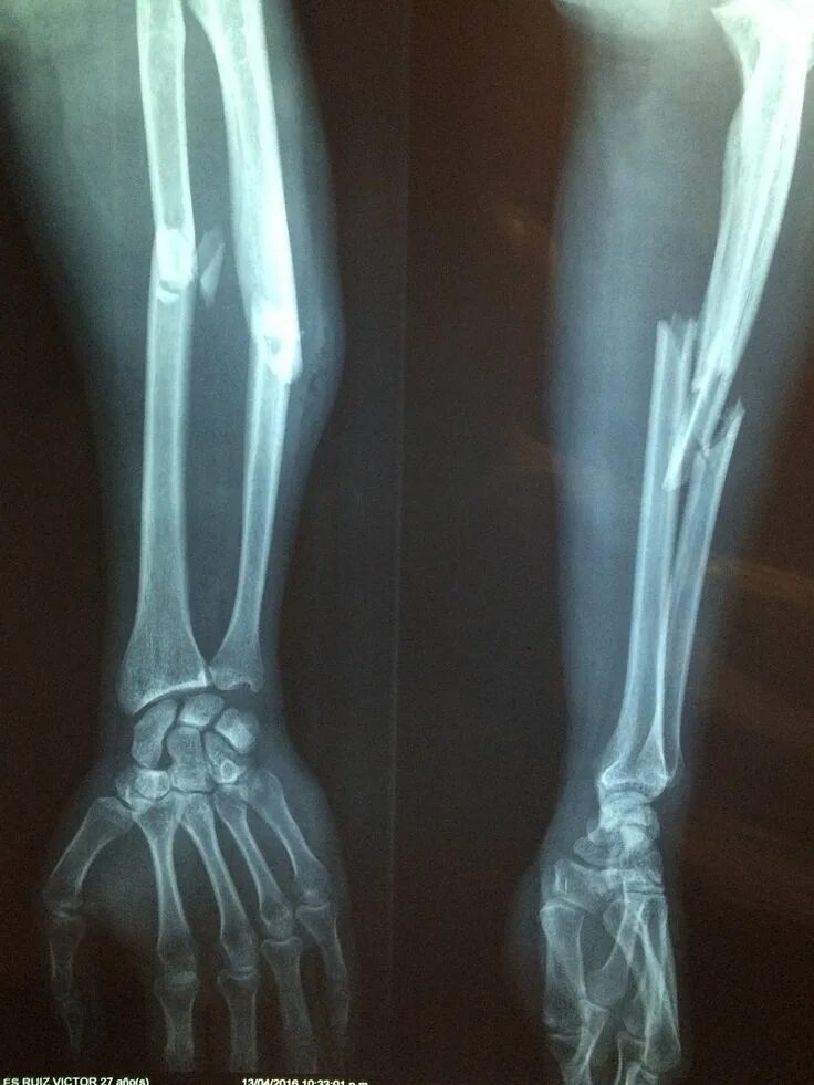 A fracture is a broken bone