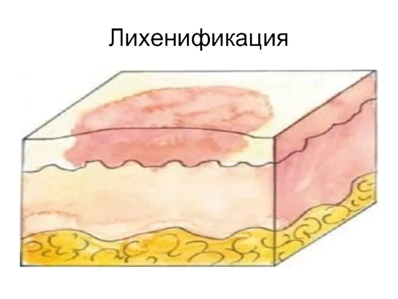 Вторичные морфологические элементы лихенификация. Лихенификация кожного покрова. Трещина вторичные элементы. Эпидермис дерма подкожная клетчатка рисунок. Усиление кожного рисунка.