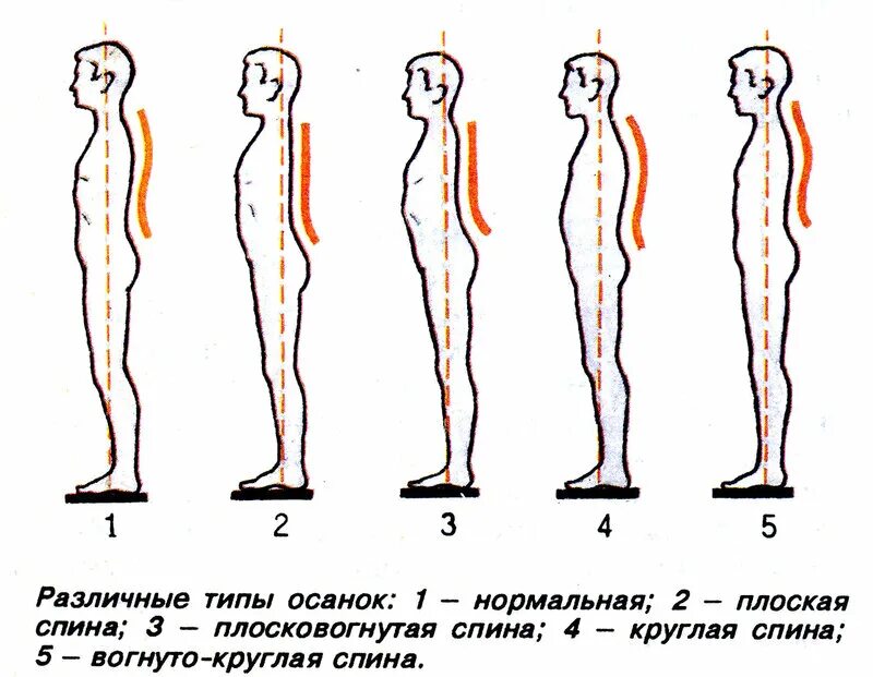 Нормальная поясница. Нарушение осанки сутулость. Типы нарушения осанки в сагиттальной плоскости. Тип осанки сутулая спина. Нормальное положение позвоночника вид сбоку.