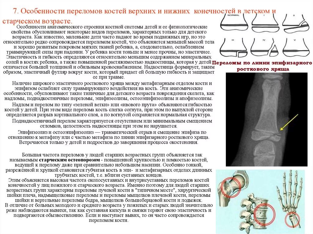 Особенности перелома плечевой кости у детей. Особенности диагностики переломов. Особенности диагностики переломов у детей. Характеристика переломов костей.