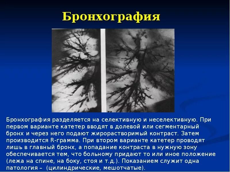 Бронхография при бронхоэктатической болезни. Контрастная бронхография. Бронхоскопия при бронхоэктатической болезни. Контрастная бронхография. Бронхография пневмония.