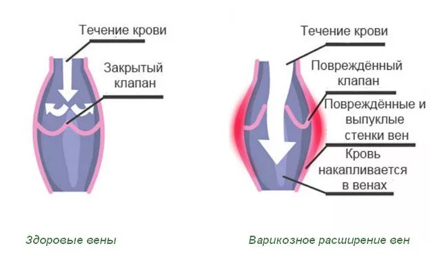 Варикоз малого таза причины. Варикозное расширение вен малого таза 1 степени. Варикозно расширенные вены малого таза. Варикозное расширение тазовых вен. Варикозное расширение вен малого таза 3 стадии.