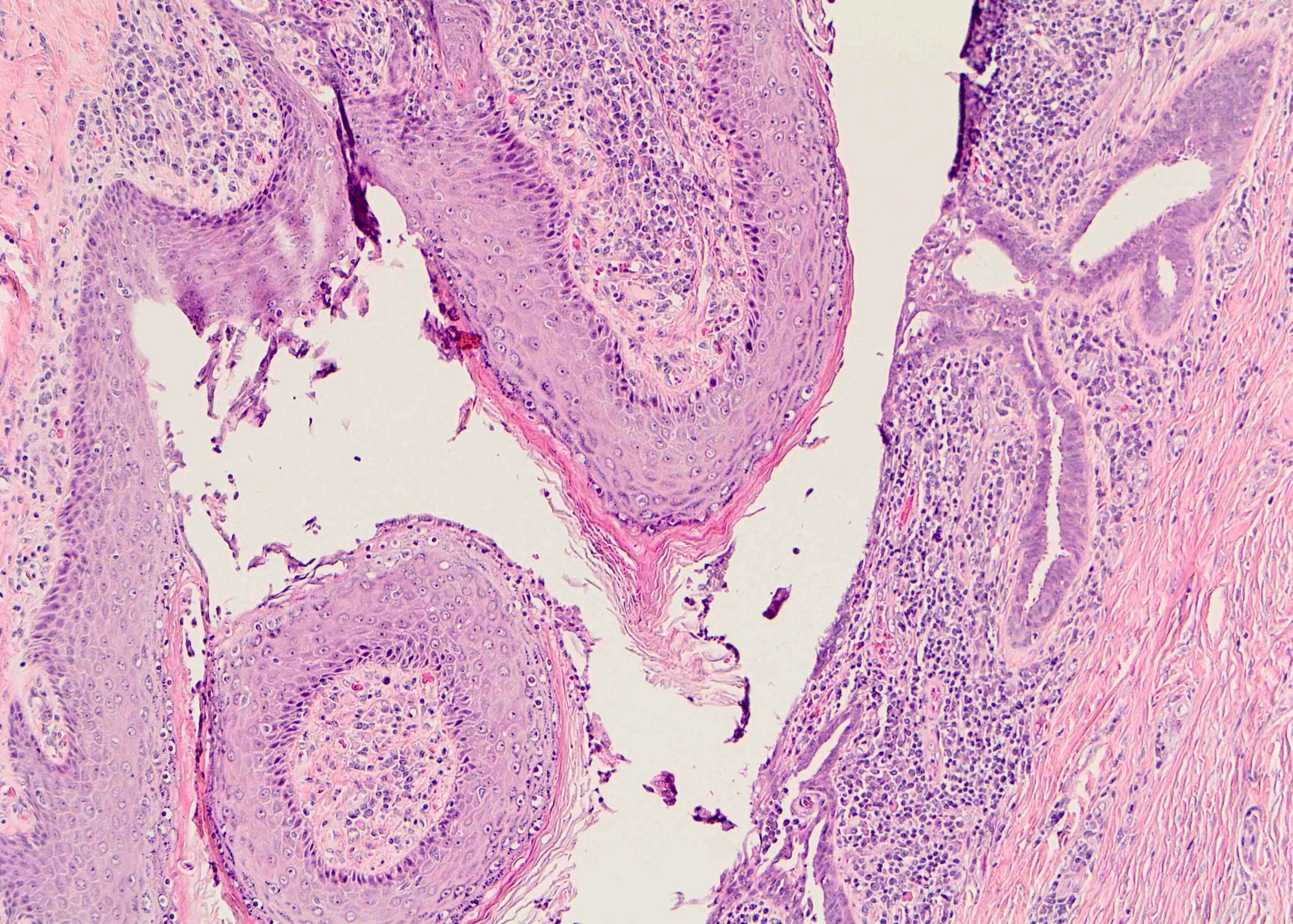 Плоскоклеточная папиллома гистология. Плоскоклеточная папиллома пищевода гистология. Метаплазия шейки матки гистология. Плоскоклеточная метаплазия шейки матки гистология. Умеренно дифференцированный плоскоклеточный рак