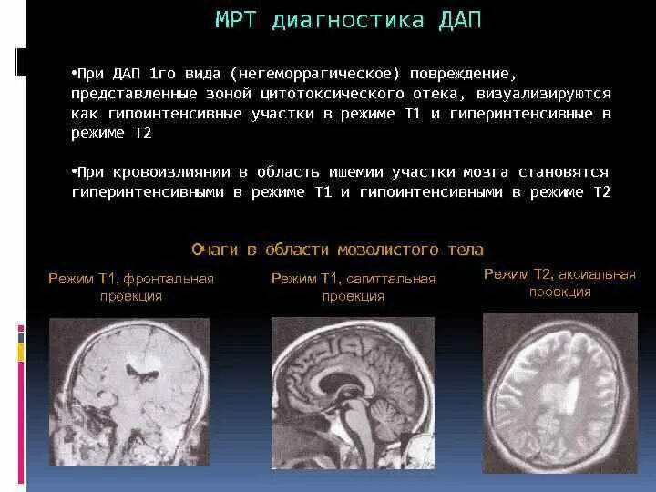 Т2 гипоинтенсивный