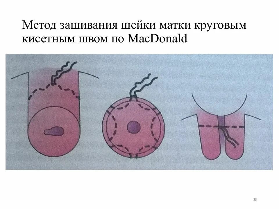 Циркулярный шов на шейку матки методика. Наложение шва на шейку матки по Макдональду. Наложение швов на шейку при ИЦН. П образный шов на шейку матки. Швы при ицн