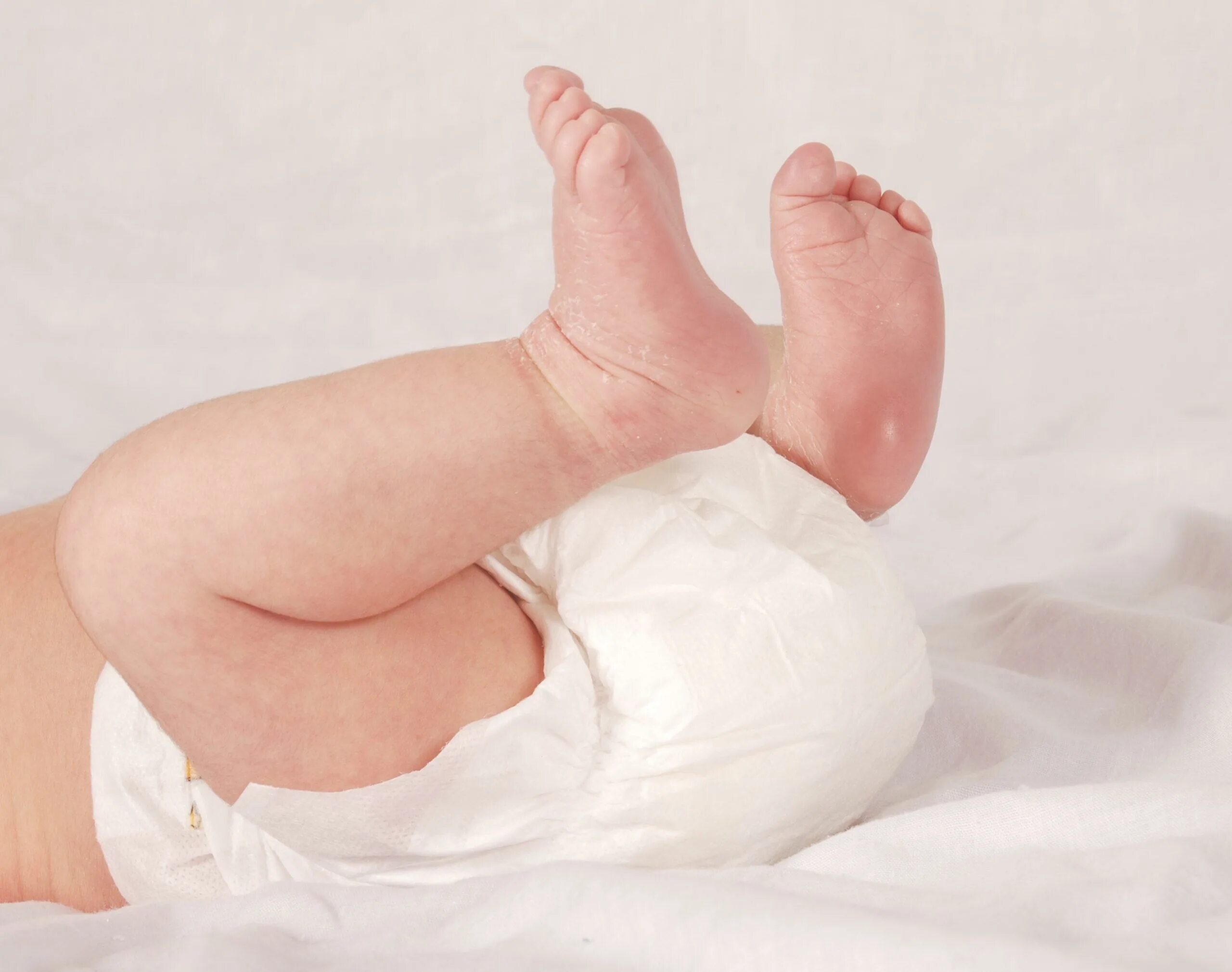 Пеленочный дерматит у новорожденного. Физиологические отеки новорожденного.