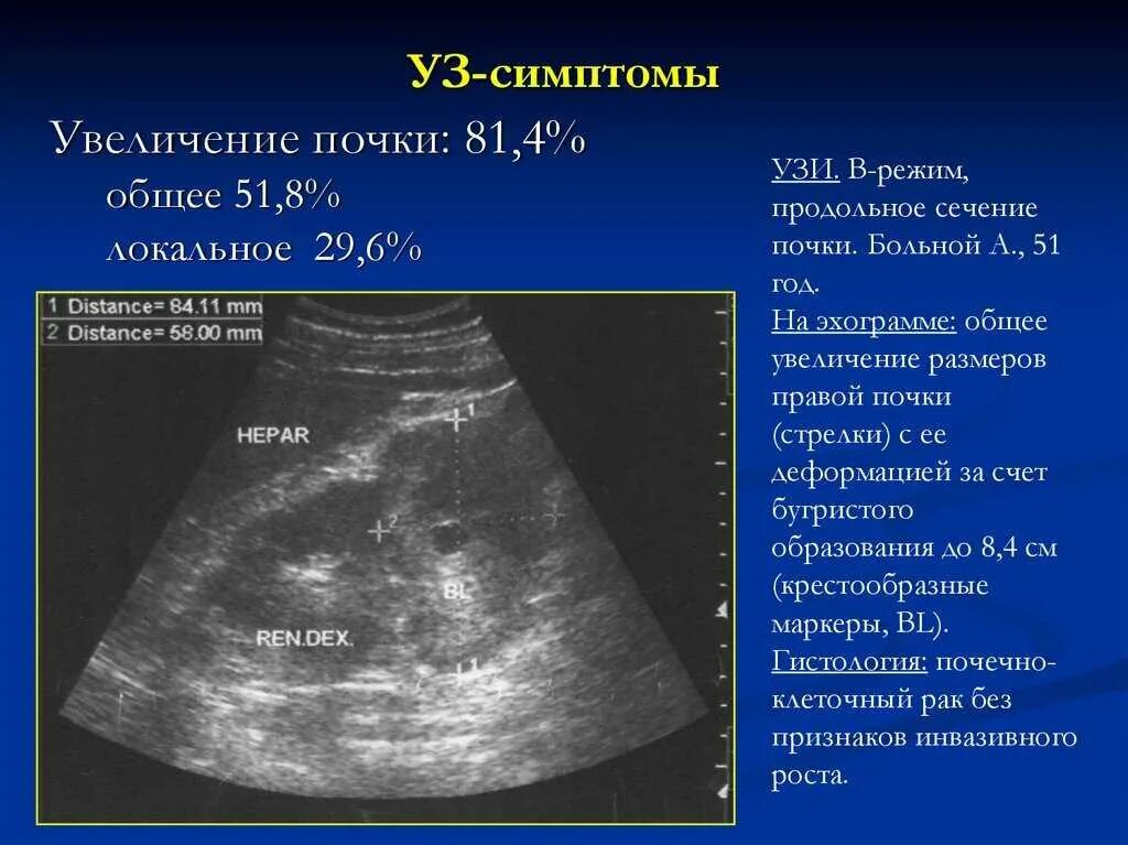 Утолщение паренхимы почек. Ультразвуковые признаки опухоли почки. опухоль почки почки узи. узи почек нефроптоз. объемное образование в почке на узи что это.
