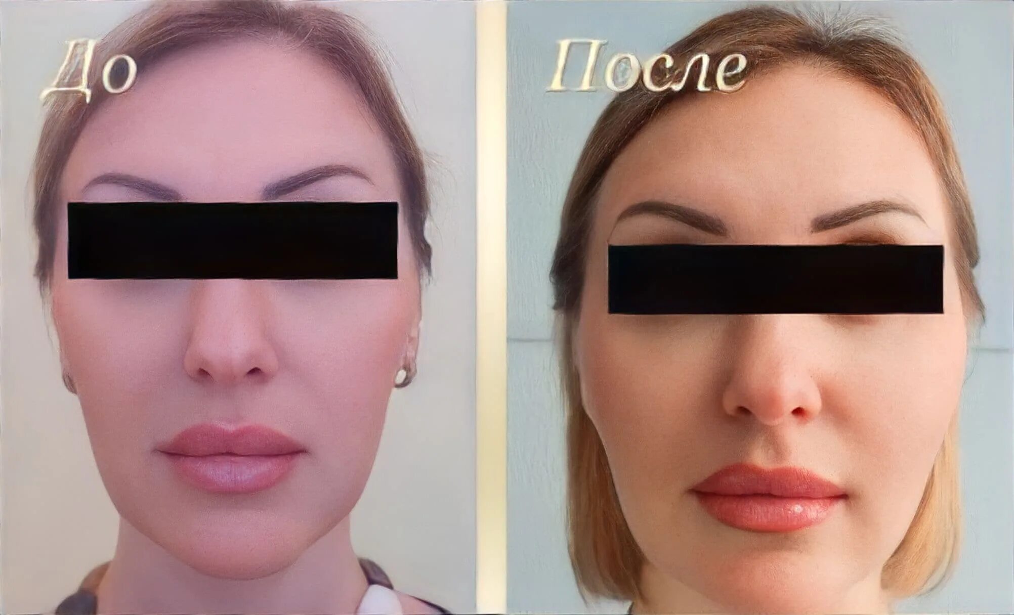 Липофилинг ягодиц фото до и после. Пластический хирург липофилинг век. Ринопластика и подтяжка одновременно. Липопластика лица. Липофилинг нижней трети лица.