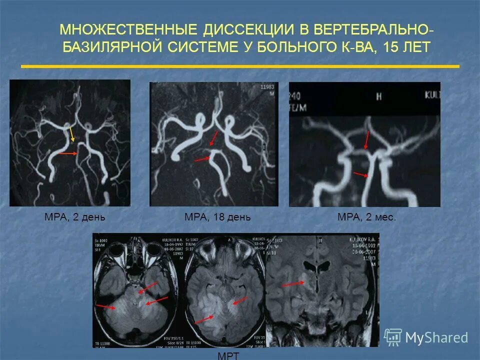Диссекция позвоночных. Каротидная артериальная диссекция. диссекция сонной артерии мрт. диссекция вса. диссекция внутренней сонной артерии кт.