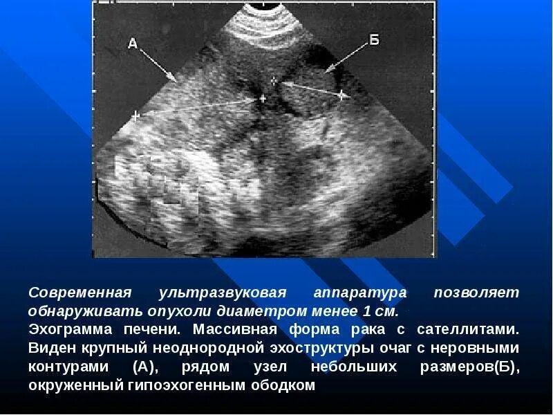 Поджелудочная диффузно неоднородная. Эхоструктура диффузно неоднородная печени. узи признаки опухоли печени. структура паренхимы печени неоднородная что это. неоднородная структура печени на узи.