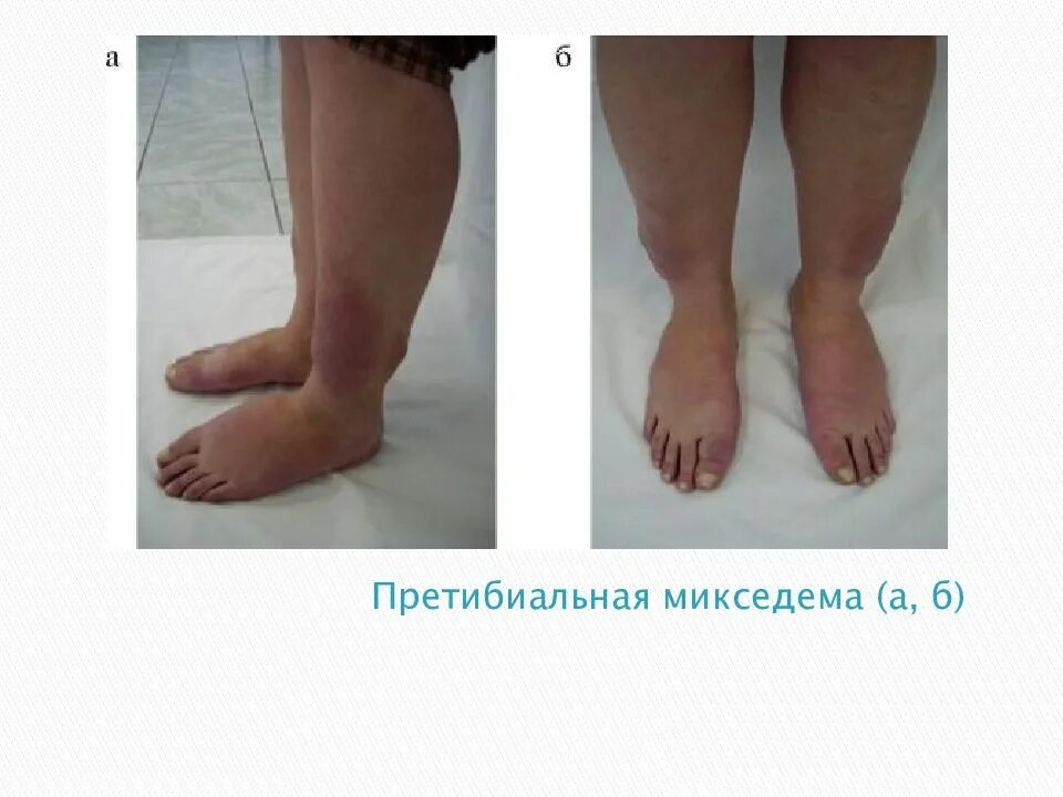 Гипотиреозе отеки (микседема). Микседема и базедова болезнь. Претибиальная микседема. Микседема что за болезнь