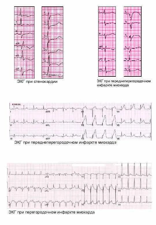 Изменение миокарда передне перегородочной области. Переднеперегородочный инфаркт миокарда на ЭКГ. ЭКГ при переднеперегородочном инфаркте миокарда. Инфаркт переднеперегородочной области на ЭКГ. ЭКГ при передне-перегородочном инфаркте миокарда.