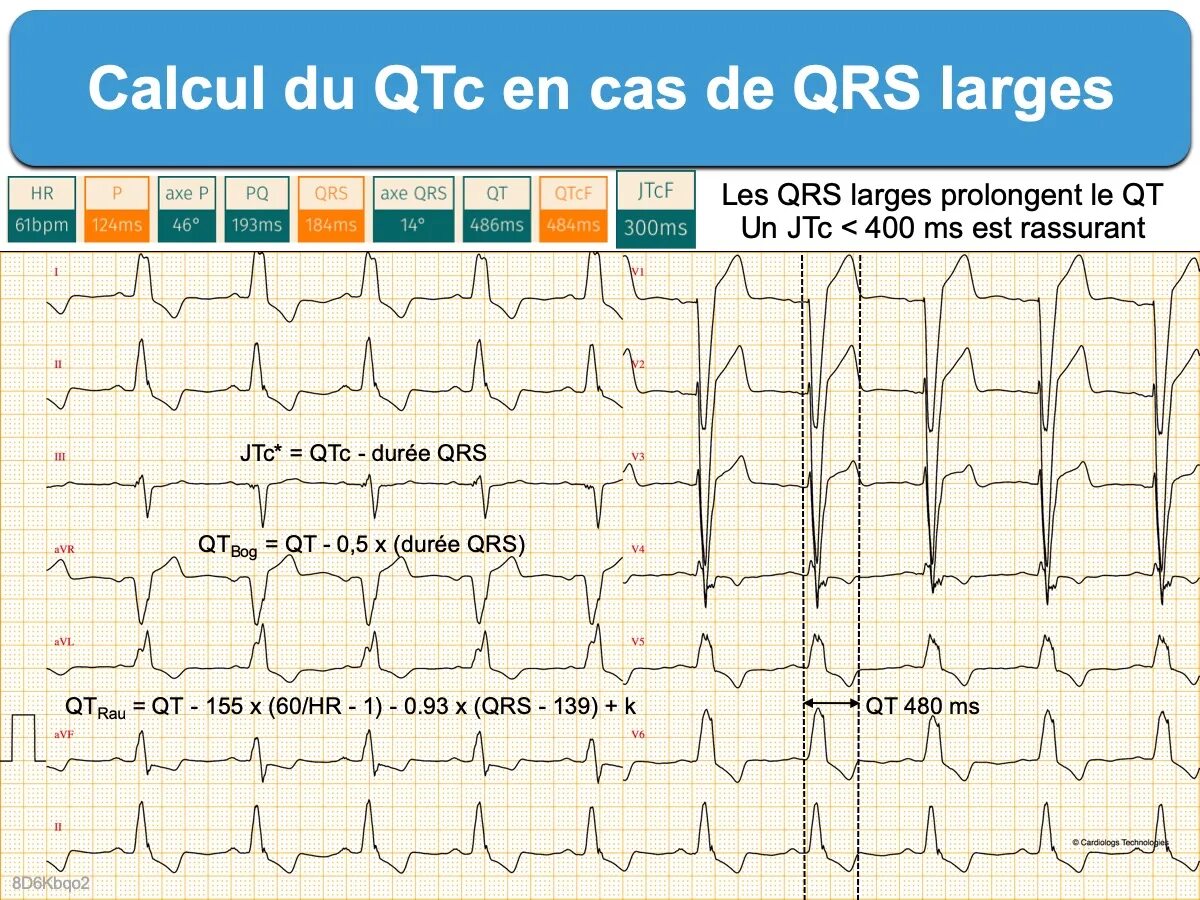 Расширение комплекса QRS на ЭКГ. Расширенный комплекс QRS на ЭКГ. Комплекс QRS 0.05. QRS 160мс.