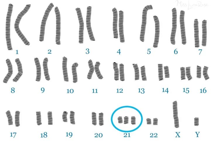 Синдром Дауна 21 хромосома. Хромосомы при синдроме Дауна. Кариотип 21 хромосомы. Синдром Дауна схема хромосом. Наличие лишней хромосомы
