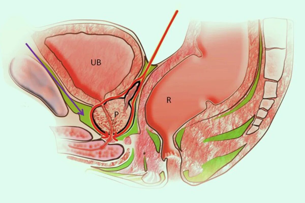 Радикальная простатэктомия с сохранением ретциева пространства. Laparoscopic Radical Prostatectomy program - Training Set.