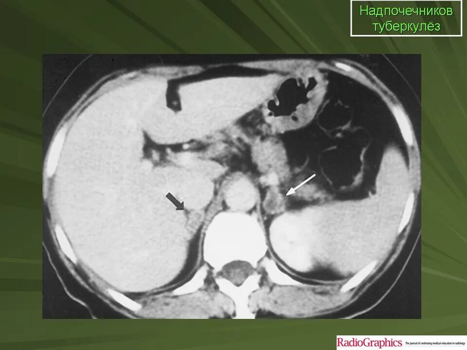 Туберкулез надпочечников. Травма надпочечника на кт. При туберкулезе надпочечника. Туберкулез щитовидной железы. Аденома надпочечника у мужчин что это