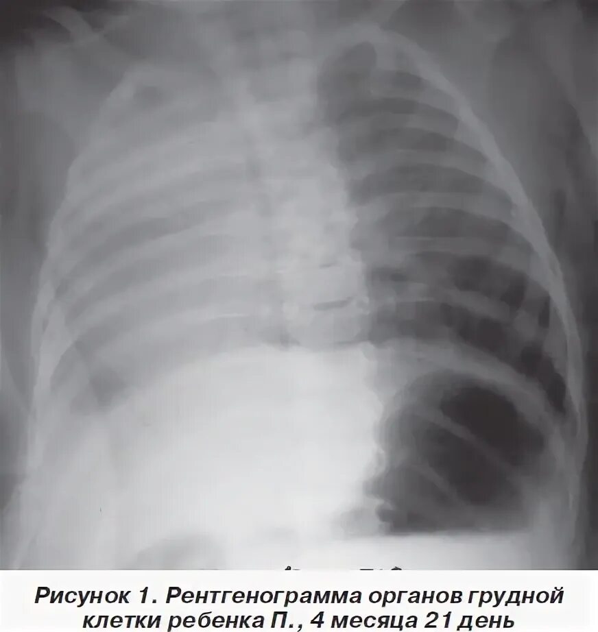 Гипоплазия 12 пары ребер