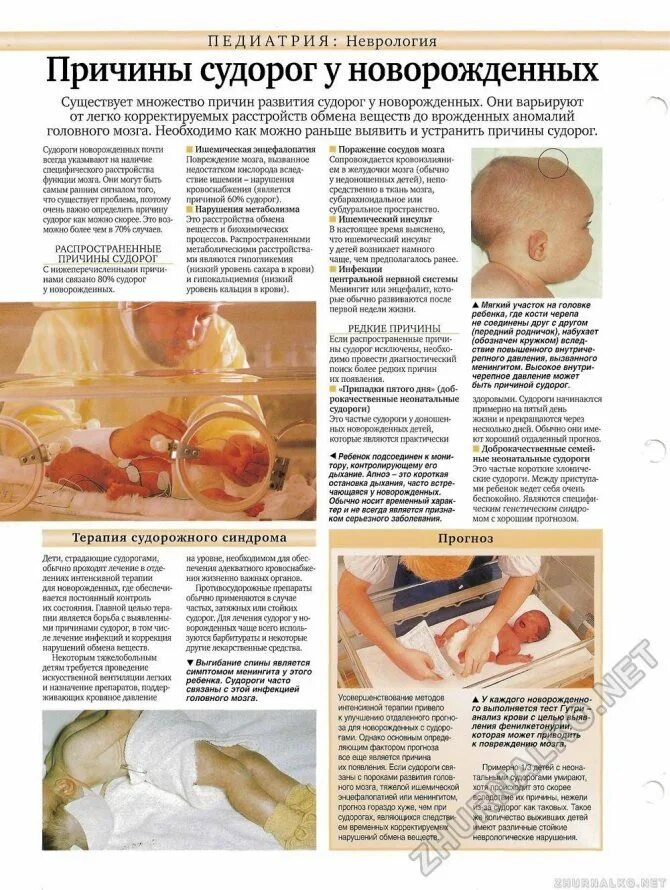 Судороги у младенца. Неонатальные судороги у новорожденного. судороги у новорожденных причины. судорожный синдром у новорожденного. причины судорог у грудничков.