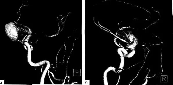 Аневризма сонной артерии что это. Фузиформная аневризма ВСА. Фузиформная аневризма сонной артерии. Аневризма супраклиноидного отдела ВСА. Фузиформная аневризма базилярной артерии.