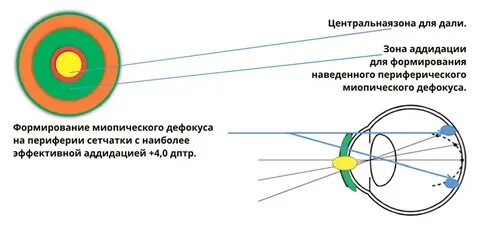 Линзы останавливающие миопию