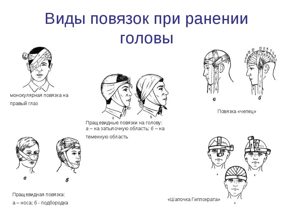 Повязка накладывается при повреждении затылка. Повязка при травме теменной области головы. При ушибленной ране теменной области на голову накладывают повязку. Повязка при ранении теменной области. Типы повязок при травмах головы.