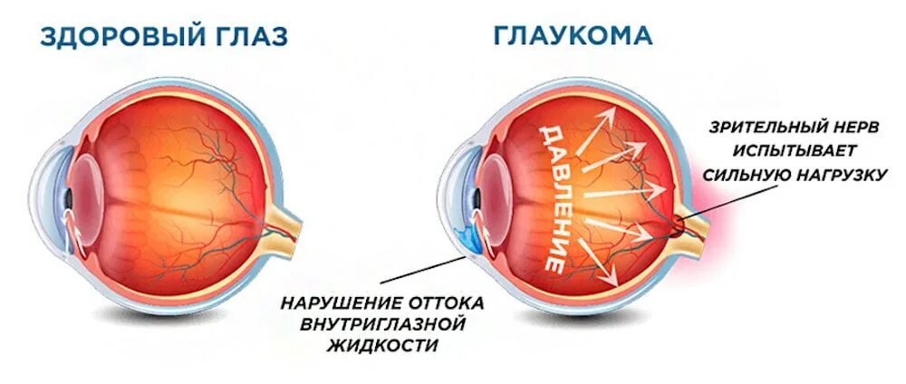 Здоровые глаза. Профилактика слепоты от глаукомы. Как выглядит здоровый глаз.