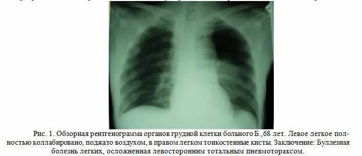 Коллабирование это. Левое легкое коллабировано. коллабирование легких. коллабилированное легкое. коллабированное легкое на рентгене.